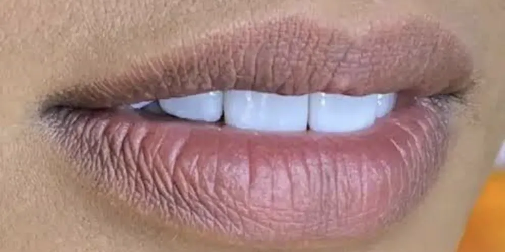 Antes da neutralização labial: lábios amarronzados e sem uniformidade