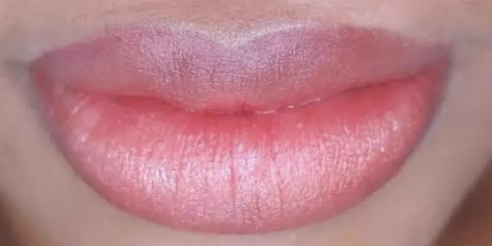 Depois da neutralização labial: lábios com cor rosada e uniforme, sem o contorno escuro
