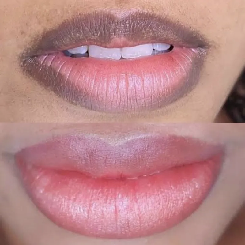 Neutralização labial: lábios com o contorno escuro antes e com cor rosada e uniforme depois
